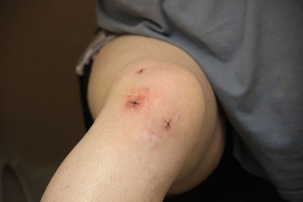 A knee showing post-surgery
