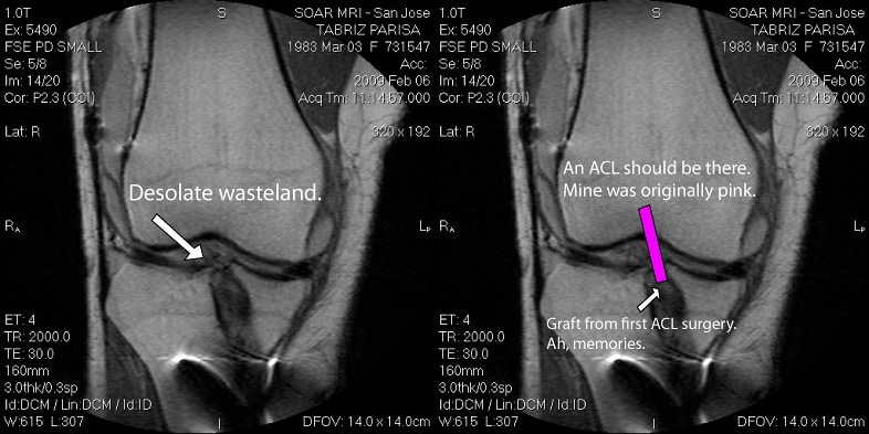 An X-ray result showing an ACL tear