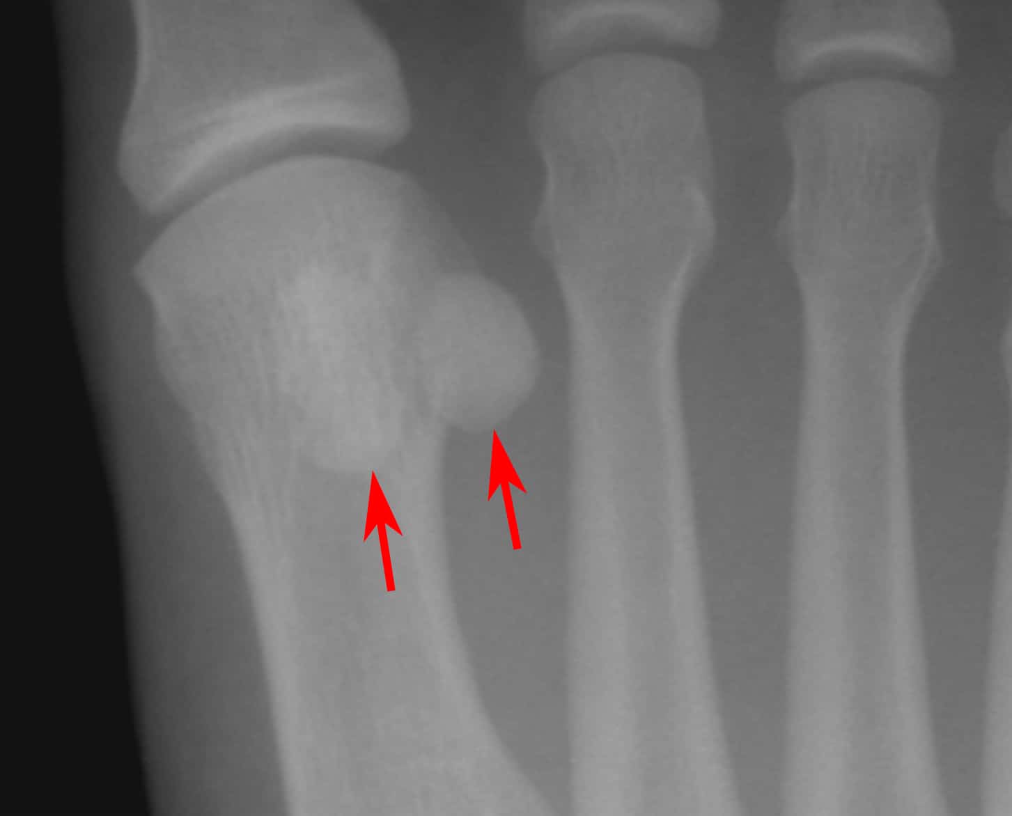 Sesamoid bones X-ray