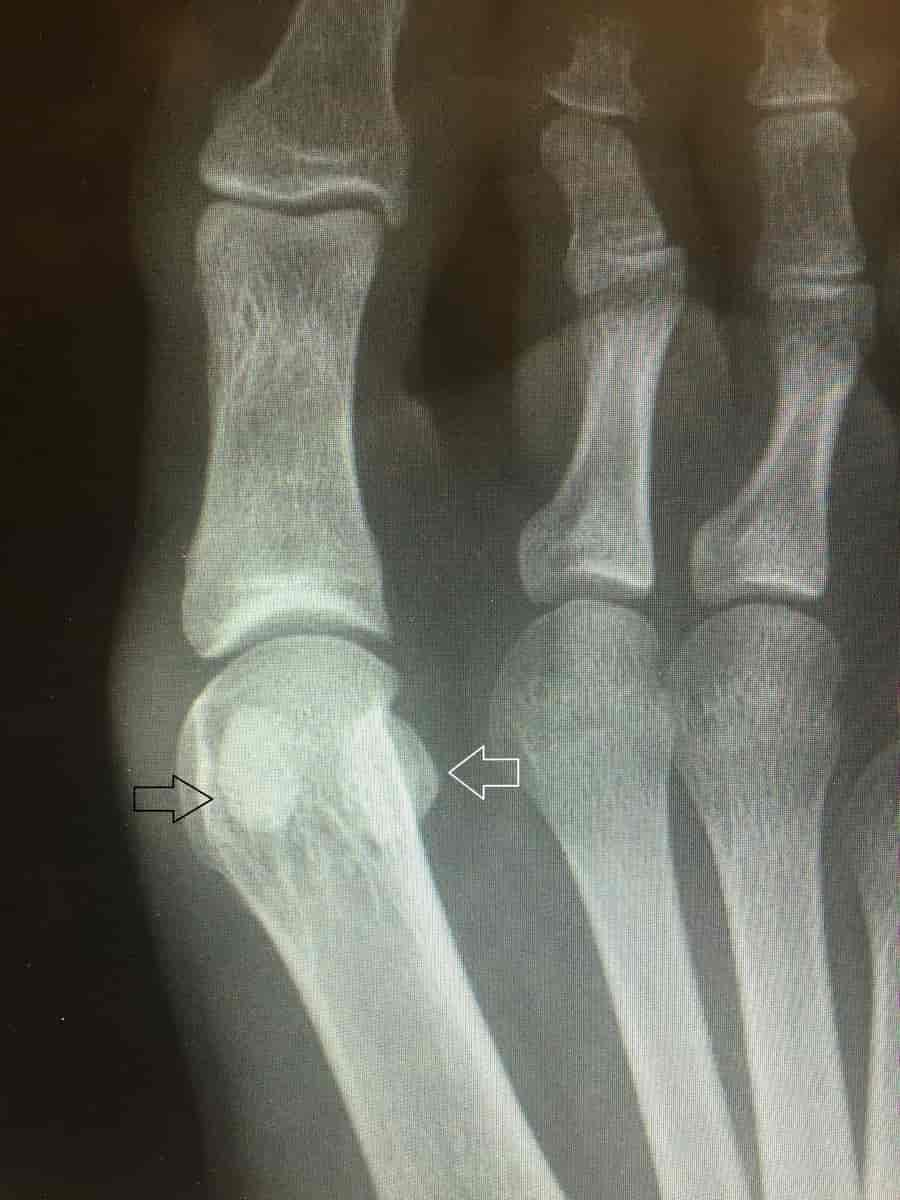 Sesamoid bones X-ray