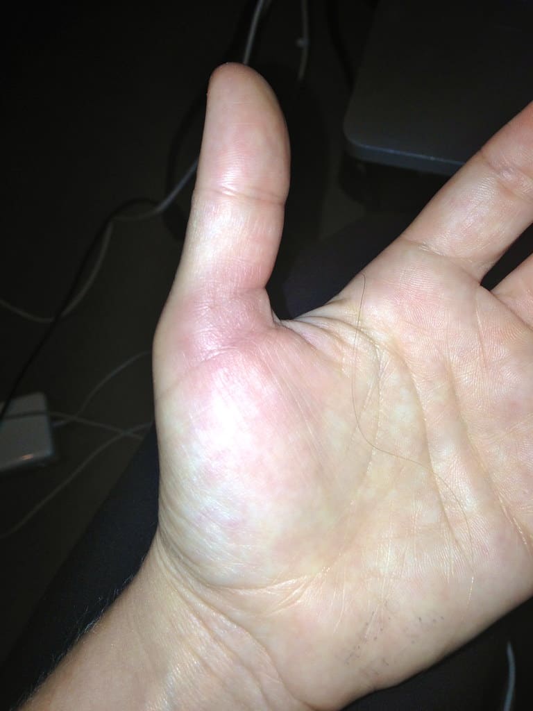 A swollen thumb up close
