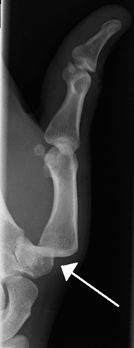 Thumb dislocation through an imaging test (X-ray)
