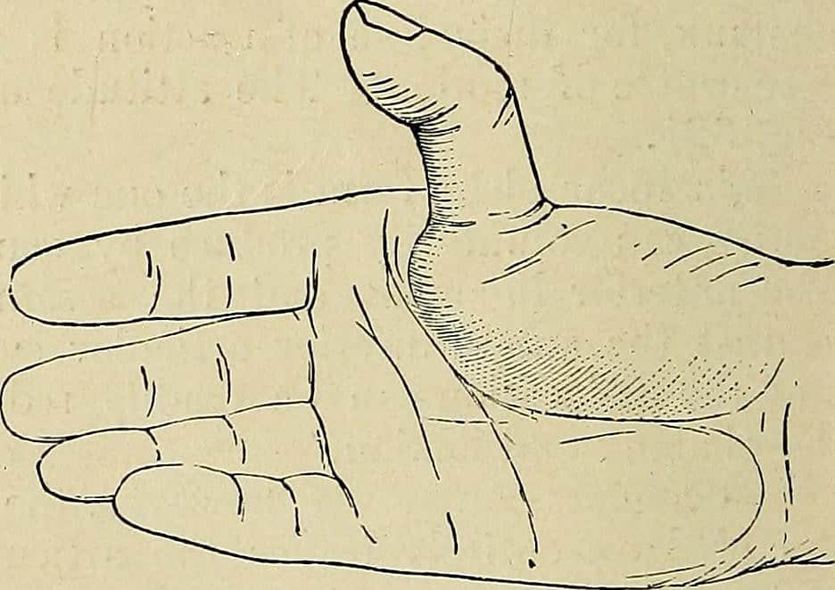 A drawing of a hand with thumb injury (dislocation)