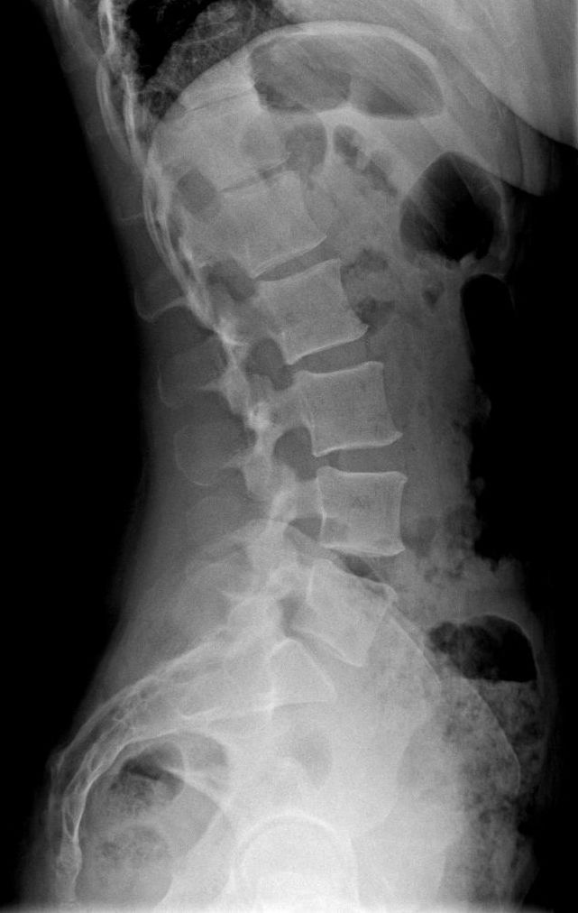 Lumbar spine X-ray