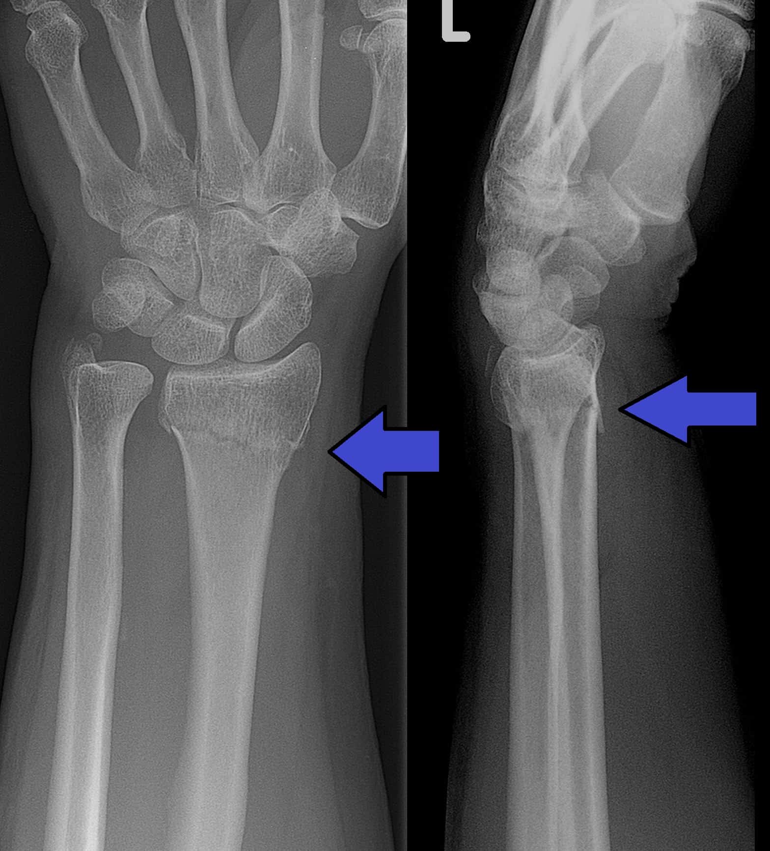 Colles fracture X-ray
