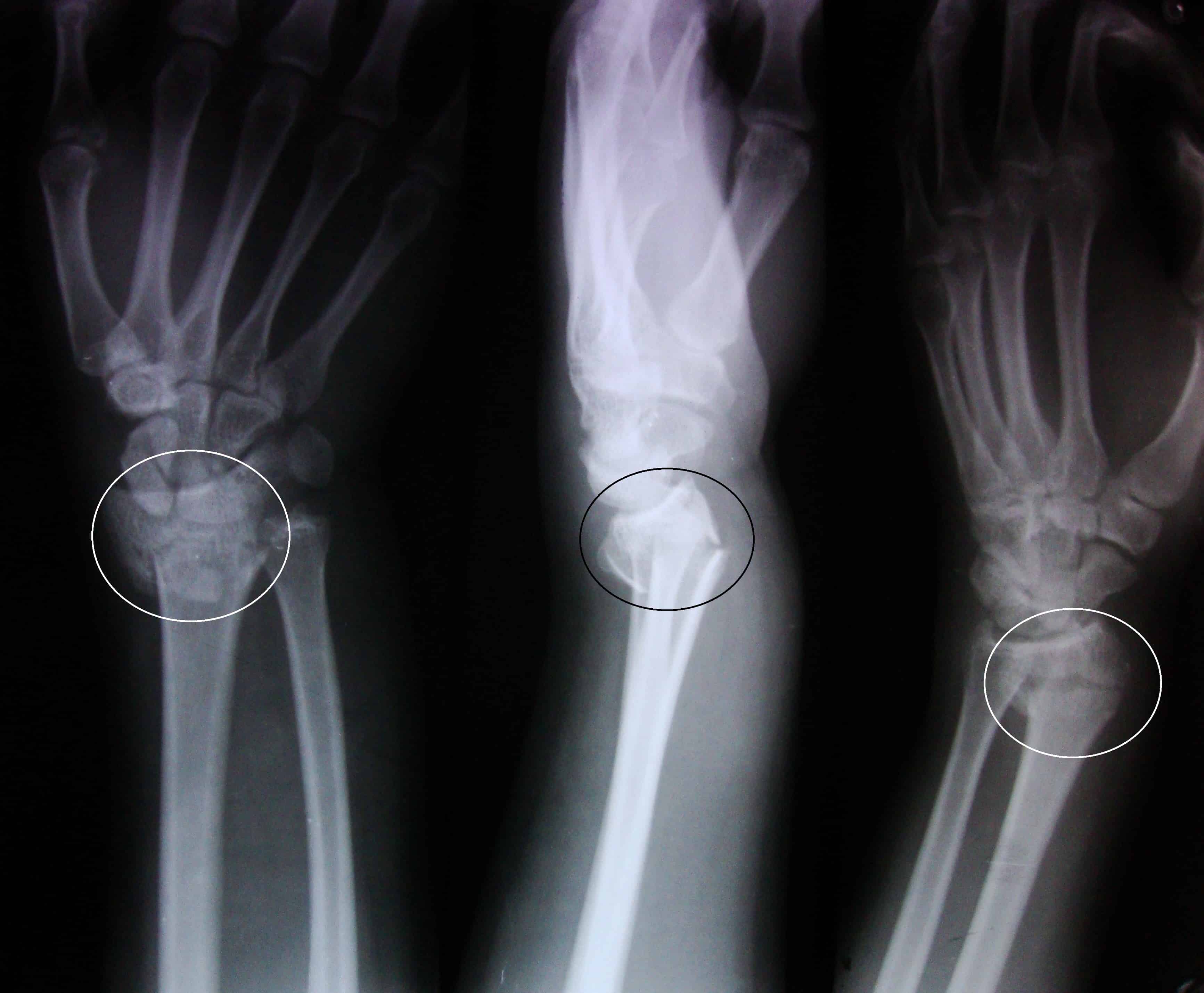 Colles fracture X-ray