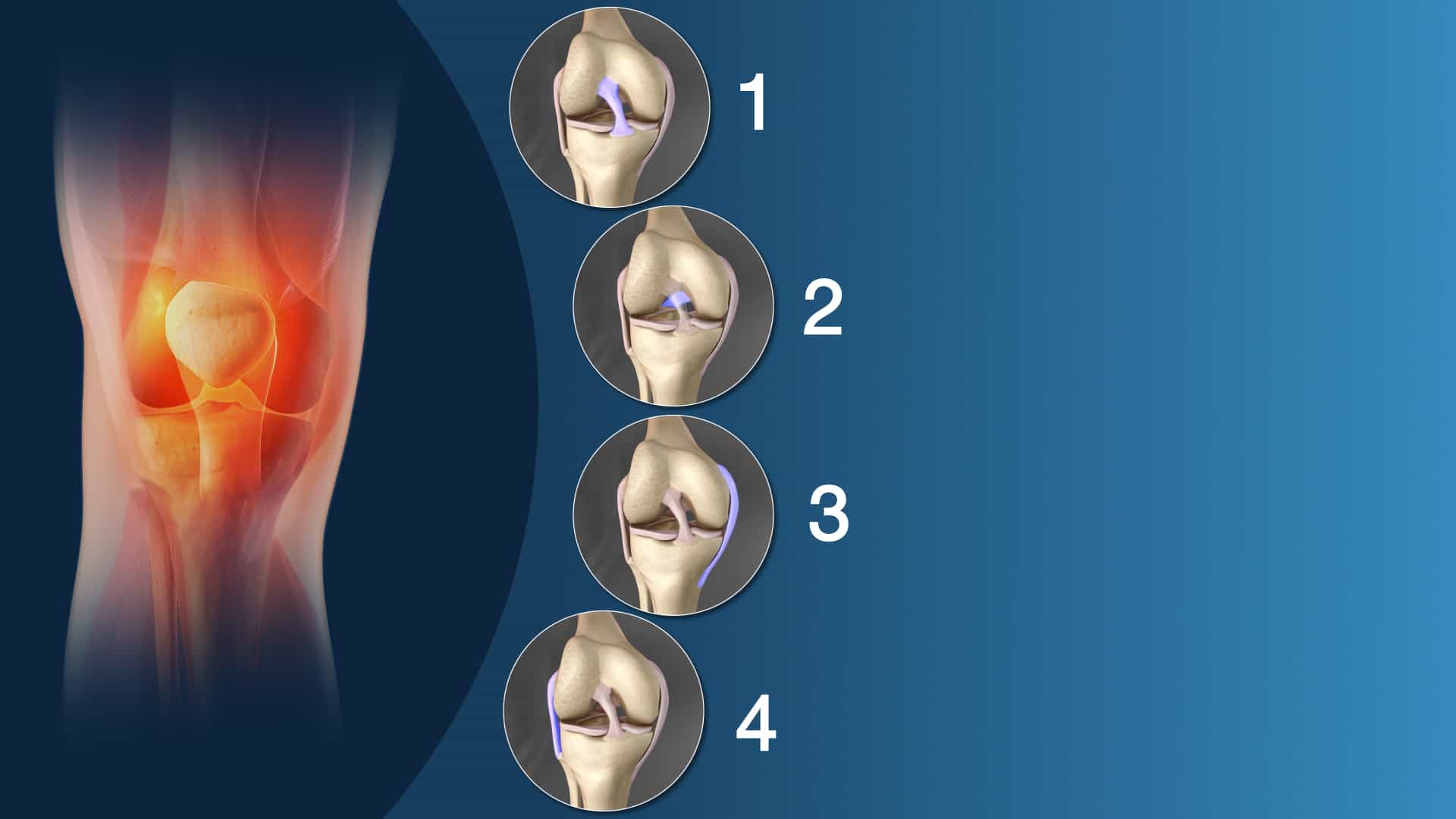 An infographic of knee sprain types