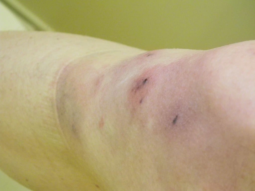 A sign of swelling and bruising on the knee