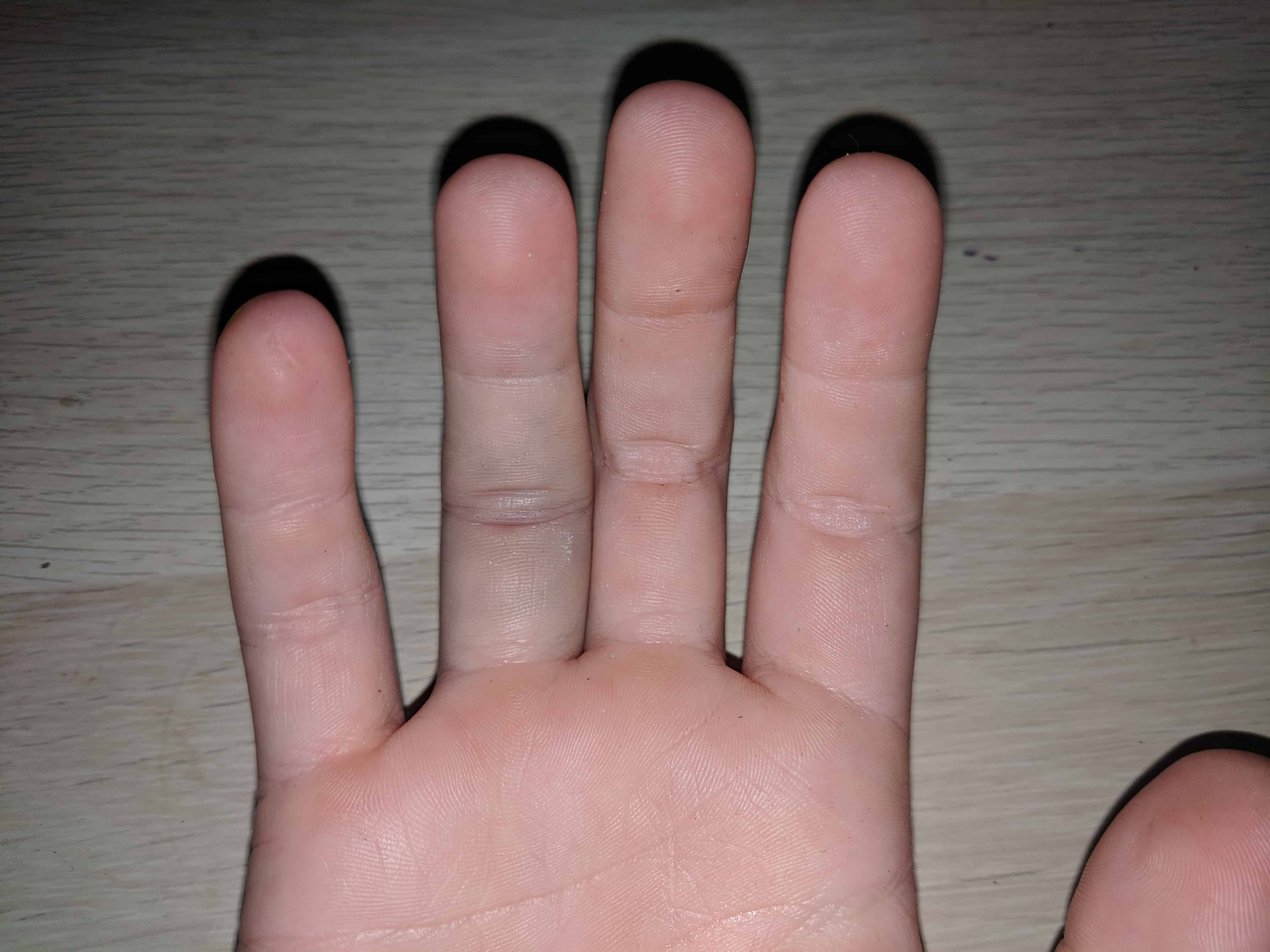 A close up shot of a hand with a swelling ring finger