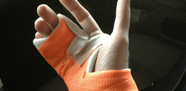 How to Treat a Sprained Finger