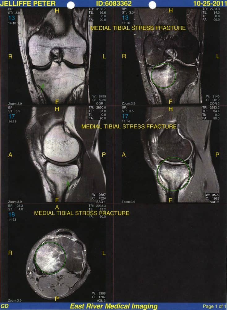 how-to-treat-a-shin-stress-fracture-physioroom-blog