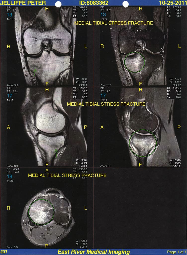 Medial tibial stress fracture imaging