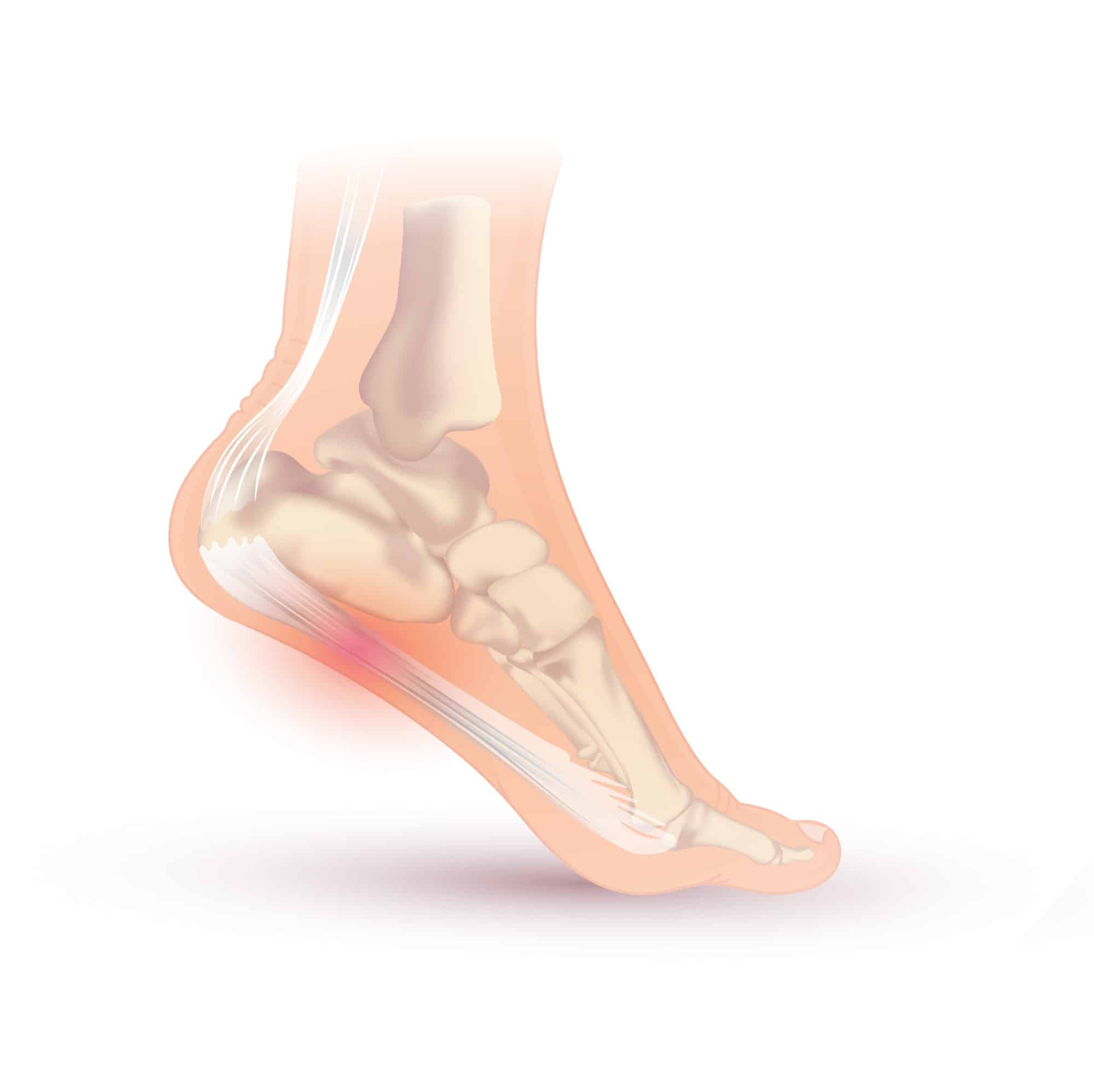 Calf Pain and Achilles Pain - Marlow Sports Therapy