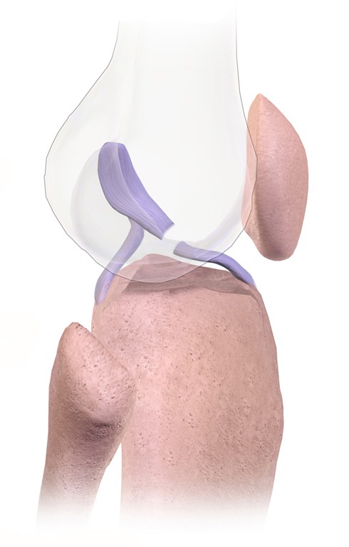 Knee anatomy showing ACL tear