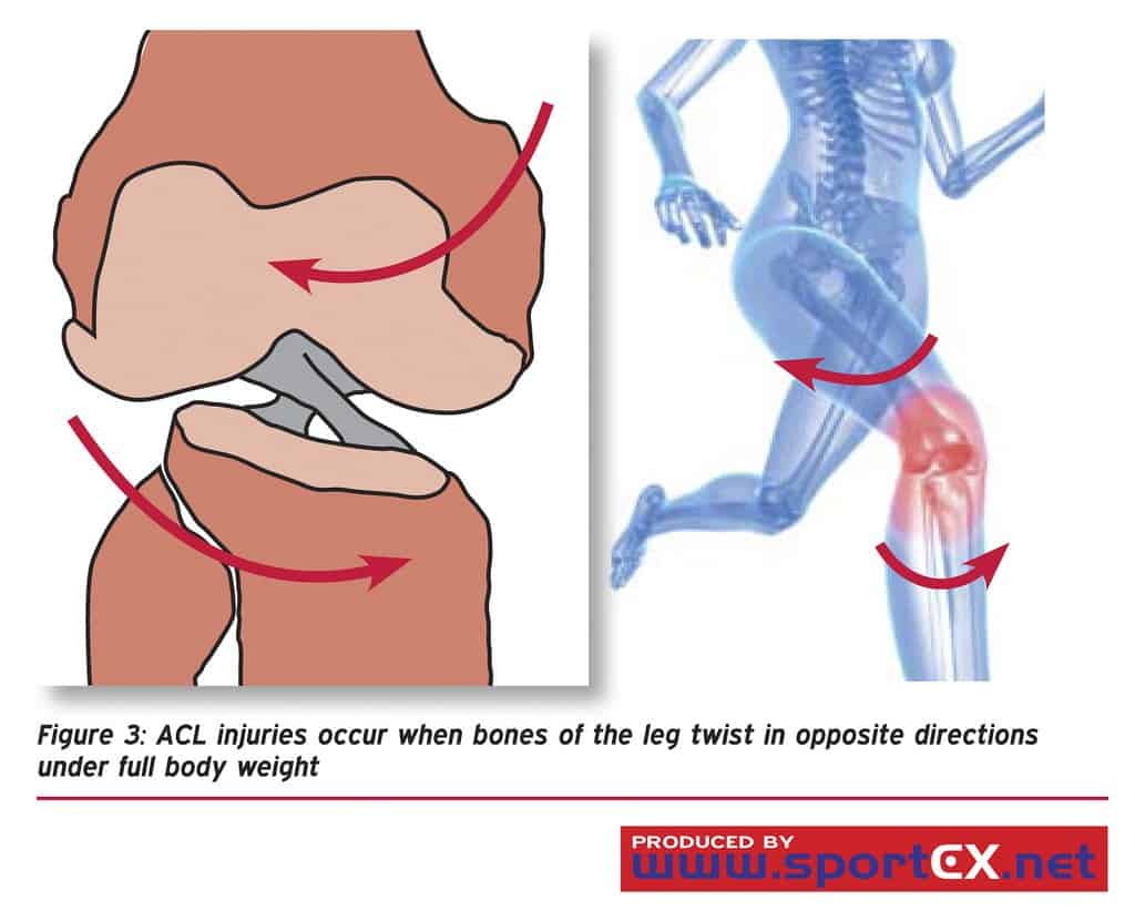 ACL tear anatomy