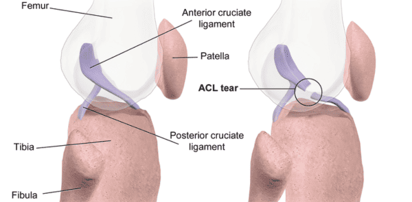 What Is an ACL Injury?