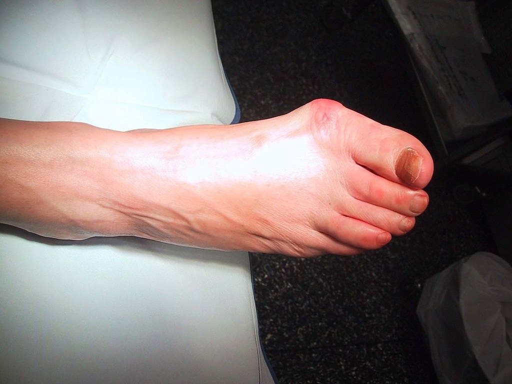 A foot of a human showing signs of bunion with swelling and redness parts