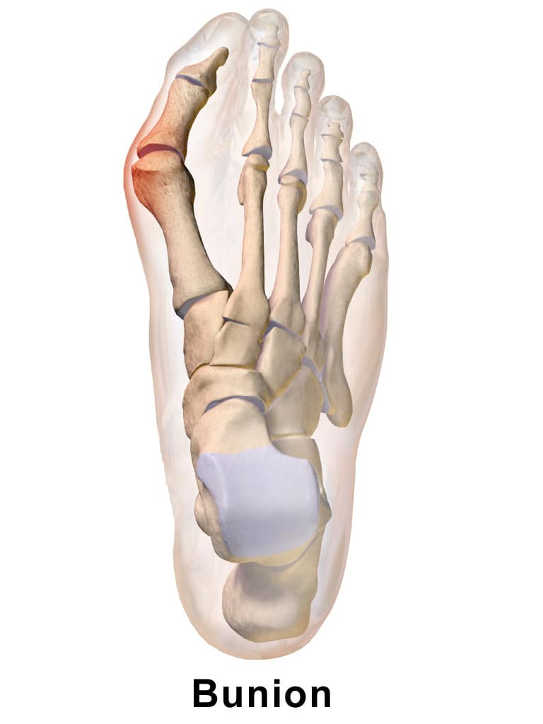 X-ray infographic of a bunion
