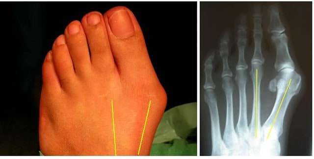 A foot with bunion, along with an X-ray showing the affected area
