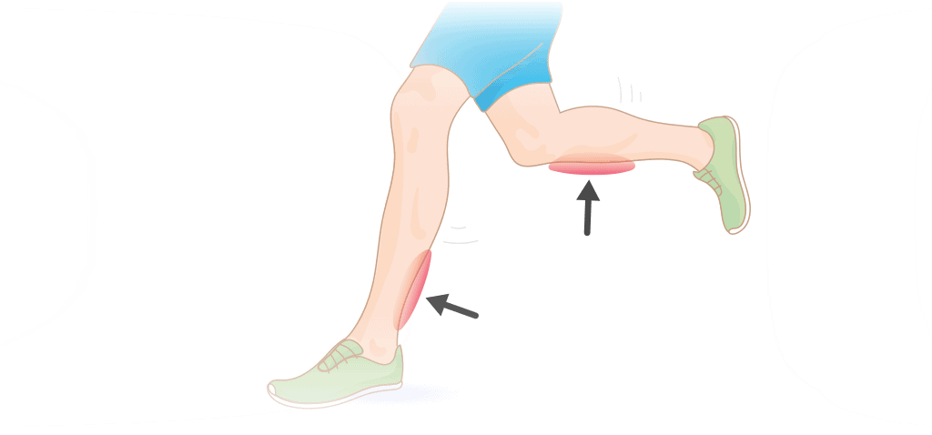 Shin splints infographic