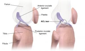 Diagram showing a tear in the anterior cruciate ligament (ACL) of the knee.