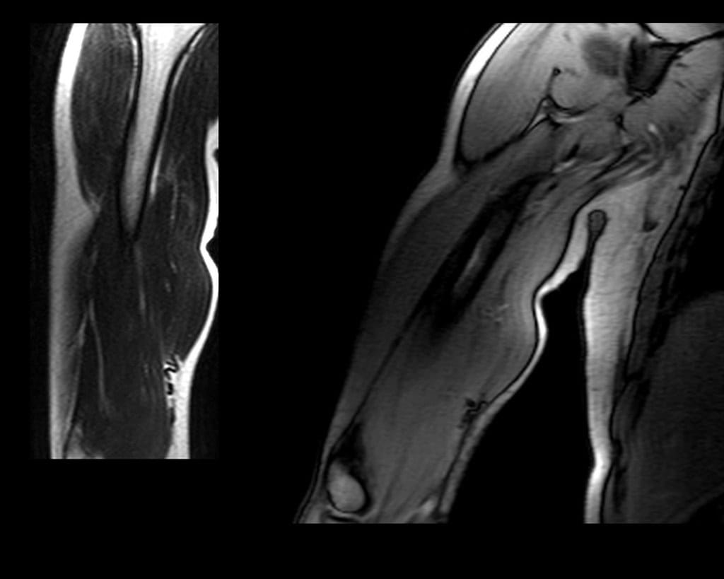 MRI scan images showing a ruptured (torn) distal bicep tendon.
